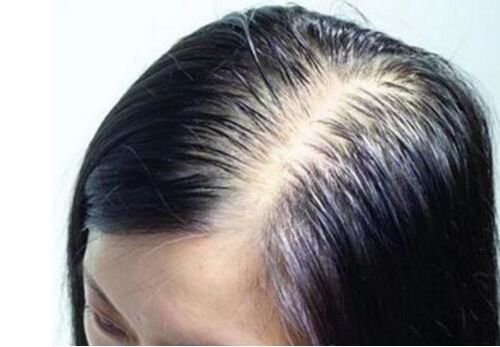 女性脂溢脱发有救吗 女性如何防止脱发掉发？ 