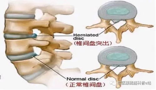 经常腰痛的你也许得了腰三横突综合征