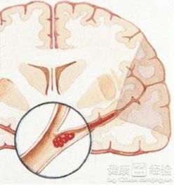 脑梗死并发症脑梗死会引发什么疾病