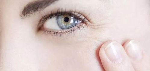 如何消除眼纹 记住这5个实用方法