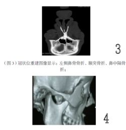 鼻骨三维ct图片 搜狗图片搜索