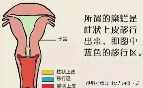 长知识 宫颈糜烂竟然不是病