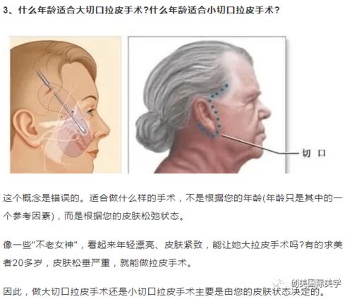 拉皮不要随便做,看完这些再决定