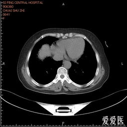 肺CT过几天出病理