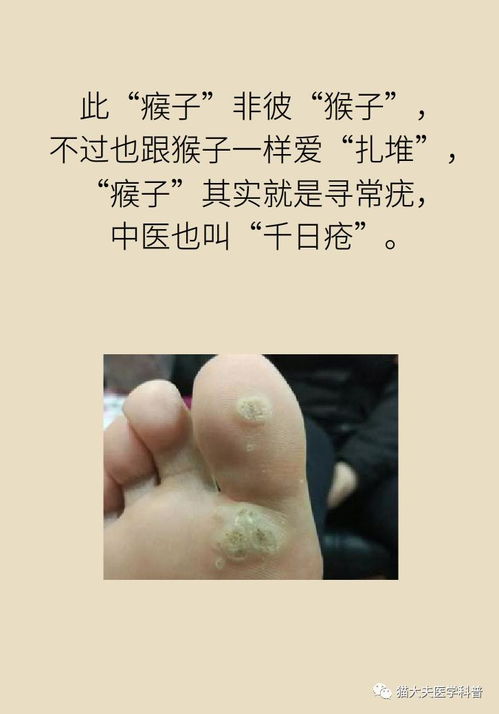 身上长瘊子,越挠它越多,竟是因为感染了HPV