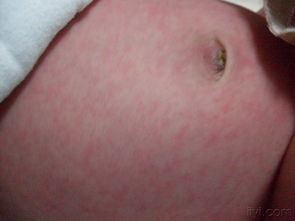 新生儿21天出现全身红疹