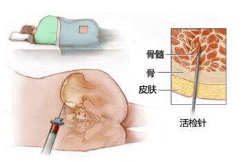 看着都疼 骨髓穿刺