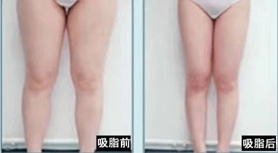 瘦腿的减肥方法有哪些