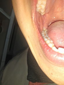 牙齿吃东西的时候酸痛,牙窝有黑线,严重吗 