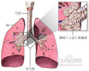 非小细胞肺癌晚期症状 