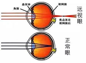 绿鸽爱眼工作室丨视力正常验光也 正常 ,是不是眼睛就正常了 不一定