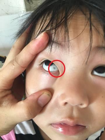 孩子眼白有 黑点 是长虫 家长别着急,多半是这2原因导致的