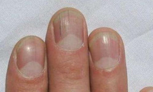 指甲有 竖纹 ,可能是身体出现的3个病症在作怪,早发现早治疗