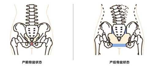 骨盆矫正 当骨盆不正的时候