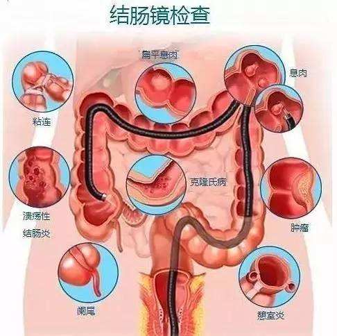 结肠息肉不容忽视,小小一个癌变率高