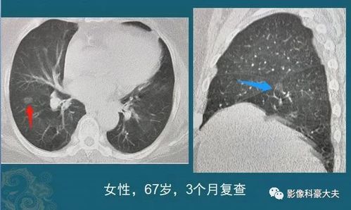 磨玻璃结节1cm,要不要动手术 看看影像科医生的分析