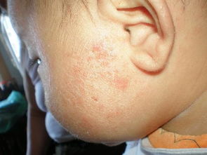 婴儿湿疹长在脸上，破皮流水怎么办