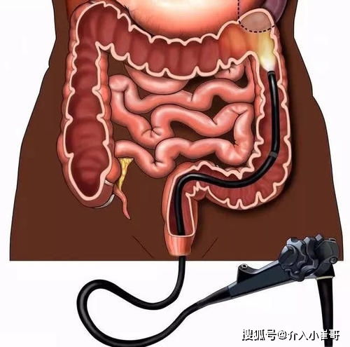 关于做肠镜检查的那些事儿