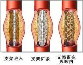 关于心脏支架和心脏搭桥,据说80 的人都 傻傻分不清