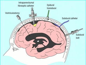 颅内压增高 搜狗百科 