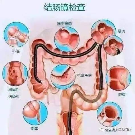 明晚8点│苏州五院消化科专家和你聊聊结直肠肿瘤