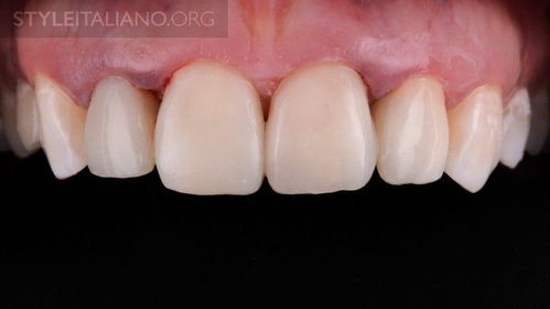 牙齿直接树脂修复的操作流程 美就是这么简单