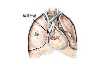 纵隔肿瘤的治疗 