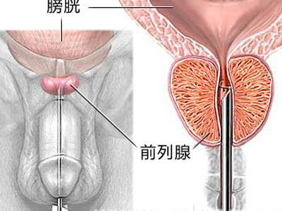 阴囊肿疼痛是怎么回事