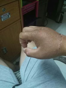 手背肌腱断裂,4只手指筋都断了,6月16做的手术,医生说接回了 