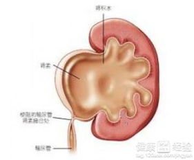 什么会导致肾积水