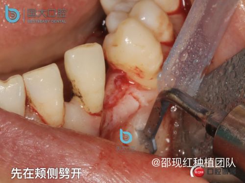 水平骨增量手术案例 单颗牙齿二次骨劈开牙槽嵴扩张术 种植术 邵现红种植团队