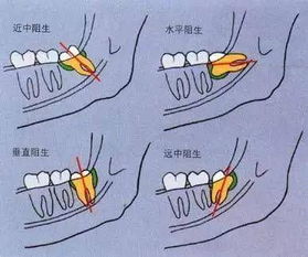 拔智齿瘦脸 年纪轻轻牙缝大 口腔溃疡会癌变 口腔那点事,总有你关心的 