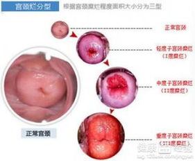 患了宫颈糜烂多吃什么水果好