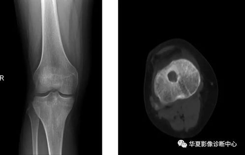 长骨内生软骨瘤