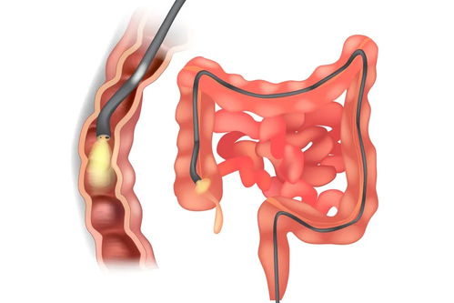 热成像：揭开肠道健康的神秘面纱