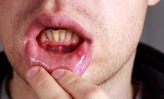 口腔溃疡可以持续1个月吗,口腔溃疡一个月都不好,为什么?