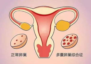 原创多囊卵巢综合征的女性，这样调理月经不调