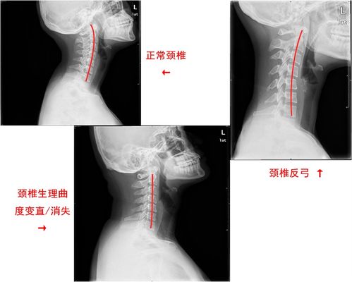 Dr怎样看颈椎生理弯曲反弓 图片欣赏中心 急不急图文 Jpjww Com