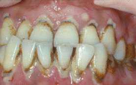牙周炎有什么危害它的症状是什么