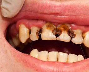 说补牙结果变成做根管治疗 这种治疗痛起来真要人命
