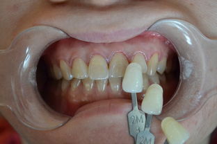 铂尔汀 让牙齿变白到底有多简单 牙齿贴面,六个步骤就搞定