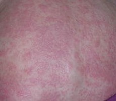 湿疹的主要症状有哪些 