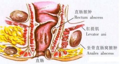 得了肛瘘,带瘘生活是什么样的体验