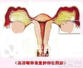 妇科卵巢囊肿(卵巢囊肿是什么病严重吗)