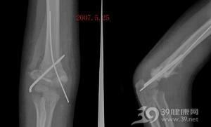肘关节骨化性肌炎再骨折 请教手术方案 米粒分享网 Mi6fx Com
