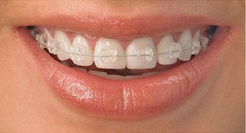 牙齿矫正的五种方式,哪种最好 哪种时间最长 