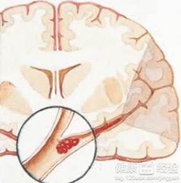 脑血栓和脑埂塞的区别