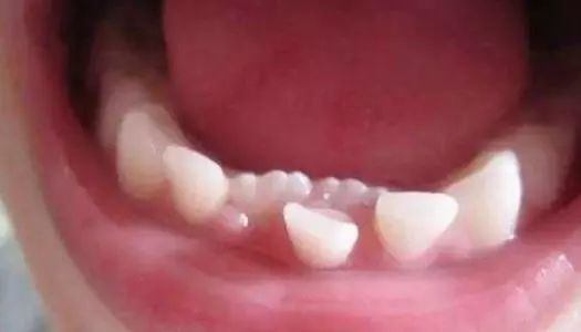 孩子饮食精细反而影响牙齿发育 小心嘴里长出 双排牙