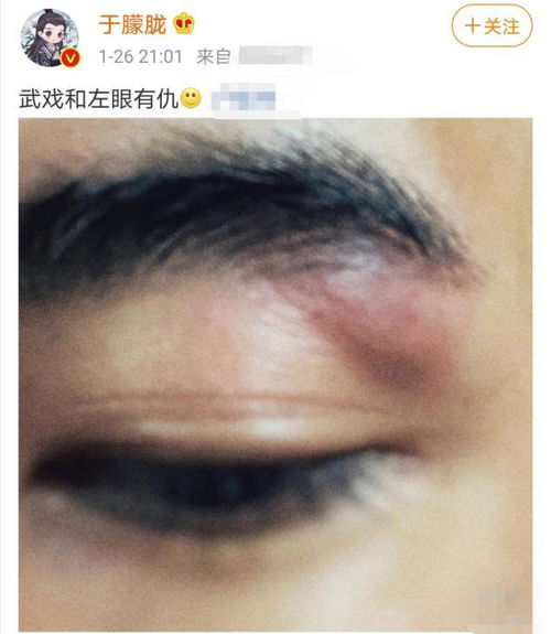 32岁男星于朦胧拍武打戏左眼受伤,眼部红肿於伤险毁容 曾被内涵靠脸走红