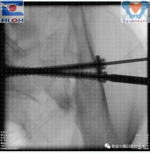 脊柱骨盆不连 骨盆垂直不稳定型骨折合并股骨干粉碎性骨折的诊疗思考